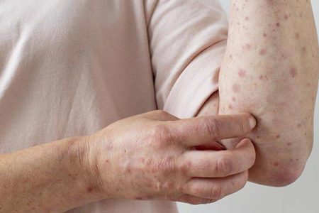 Autoridades da OMS tranquilizam sobre a Mpox, “não é nova covid”