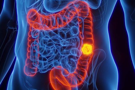 Atenção aos sinais: a importância da pesquisa de sangue oculto nas fezes no rastreamento do câncer colorretal Atenção aos sinais: a importância da pesquisa de sangue oculto nas fezes no rastreamento do câncer colorretal