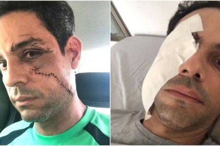 Homem leva 62 pontos no rosto após ser agredido enquanto trabalhava em festa privada