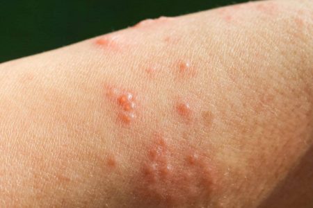 Cidade no sul da Bahia enfrenta surto de escabiose