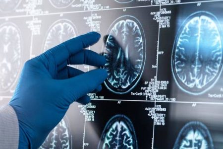 Estudo brasileiro identifica ligação entre inflamação cerebral e avanço do Alzheimer
