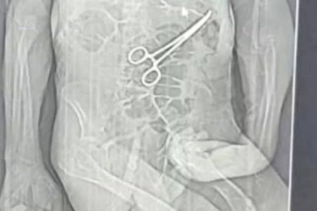 Idoso morre após cirurgia e família denuncia pinça esquecida no corpo
