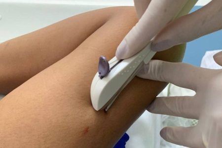 Ministério da Saúde amplia capacitação para oferta do implante contraceptivo Implanon no SUS