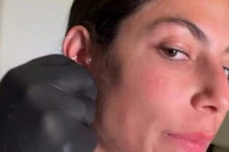 Mari Gonzalez realiza lobuloplastia a laser e celebra resultado