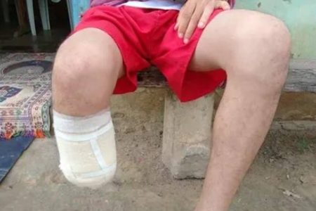 Servidor que amputou o próprio pé para tentar receber R$ 1,5 milhão em seguros tem recurso barrado pela Justiça