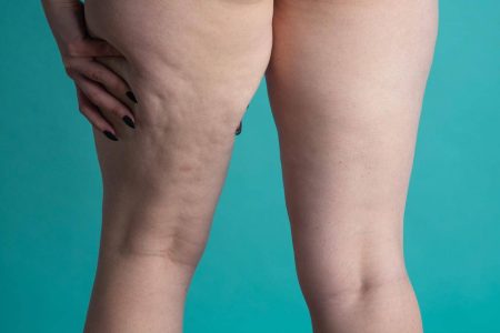 Junho Roxo chama atenção para o lipedema e reforça importância do diagnóstico precoce